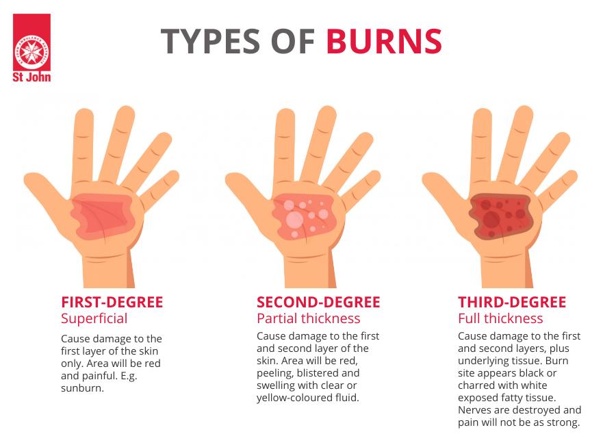 first degree burn hand