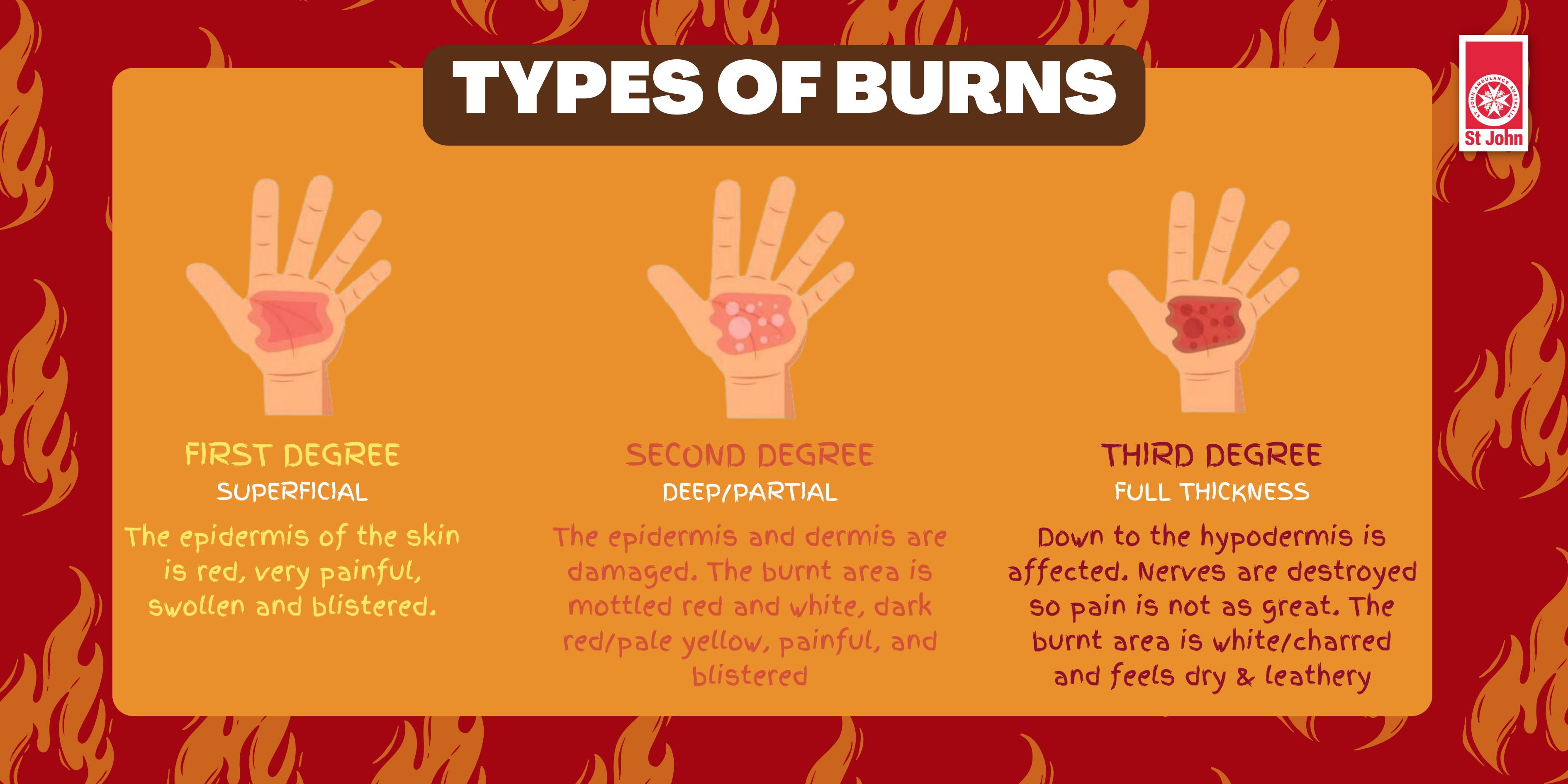 Steam Burns: Symptoms, Treatment, and Prevention